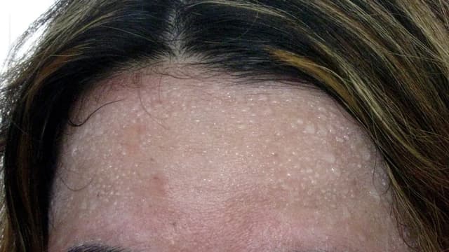 Close da testa de uma pessoa coberta de gotas de suor, com sobrancelhas e franja à mostra
